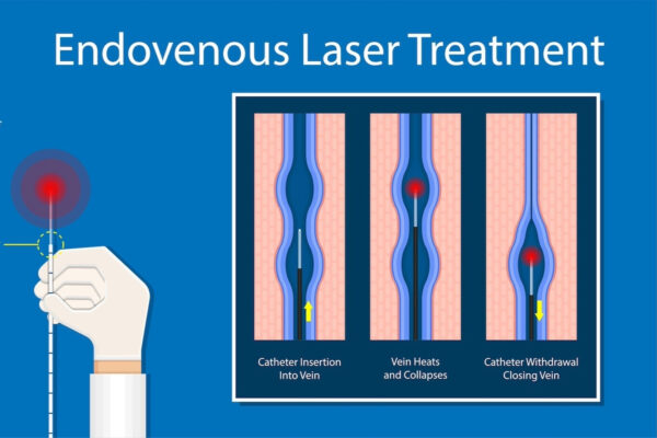 Endovenous Laser Therapy for varicose veins