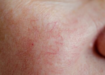 spider veins on the face