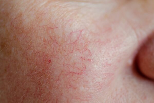 spider veins on the face