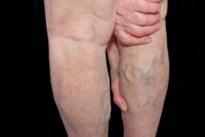 Varicose veins Centennial CO 2024